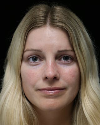 Beverly Hills Rhinoplasty Before & After Gallery - Patient 137538 - Image 4 Dr. Deepak Raj Dugar