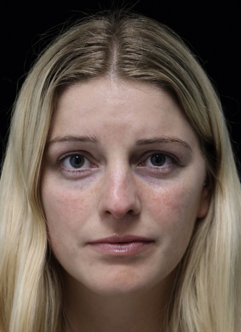 Beverly Hills Rhinoplasty Before & After Gallery - Patient 137538 - Image 3 Dr. Deepak Raj Dugar