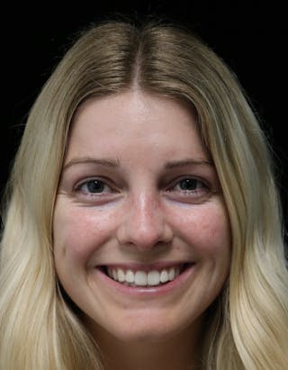 Beverly Hills Rhinoplasty Before & After Gallery - Patient 137538 - Image 6 Dr. Deepak Raj Dugar