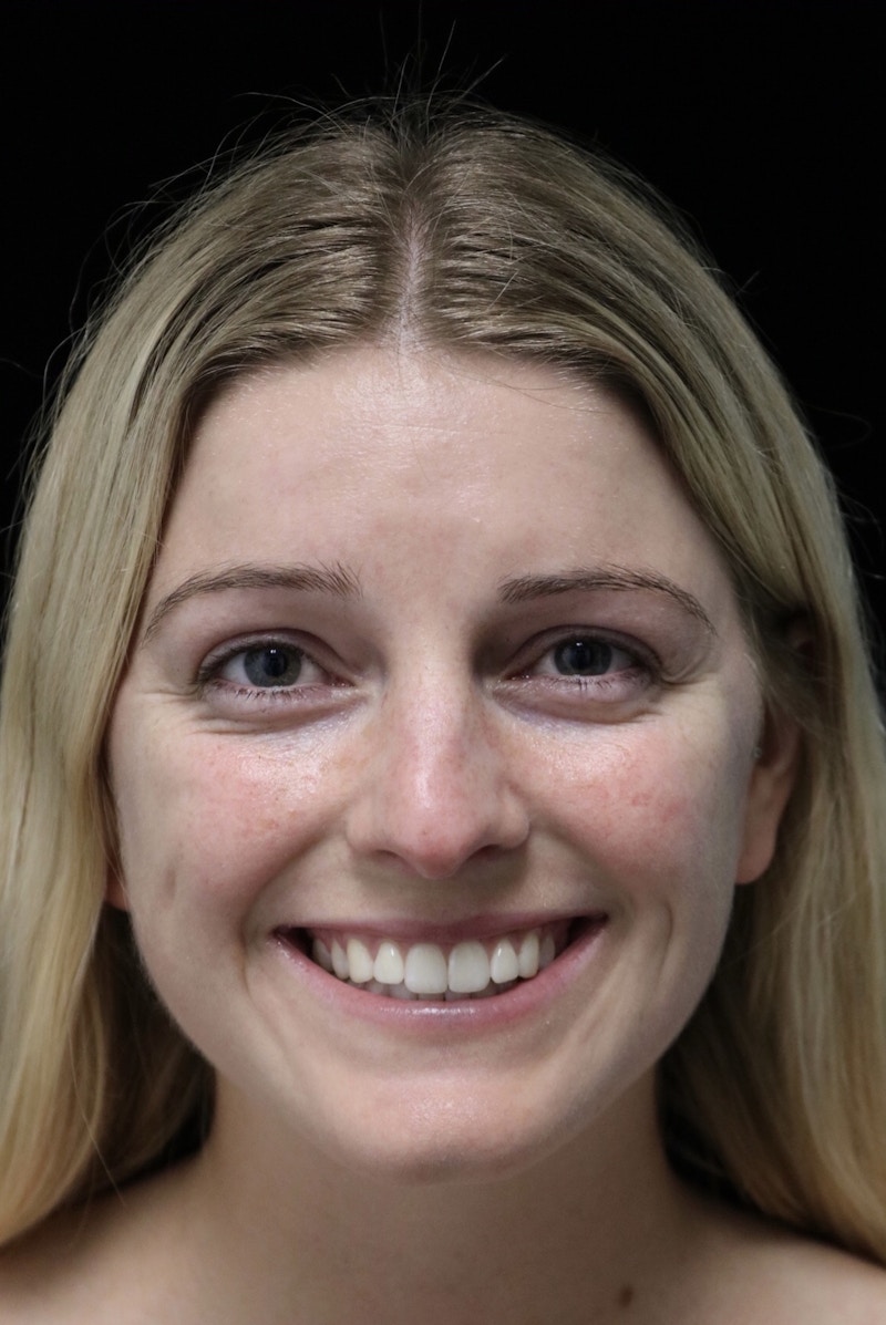 Beverly Hills Rhinoplasty Before & After Gallery - Patient 137538 - Image 5 Dr. Deepak Raj Dugar