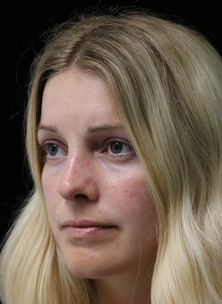 Beverly Hills Rhinoplasty Before & After Gallery - Patient 137538 - Image 8 Dr. Deepak Raj Dugar