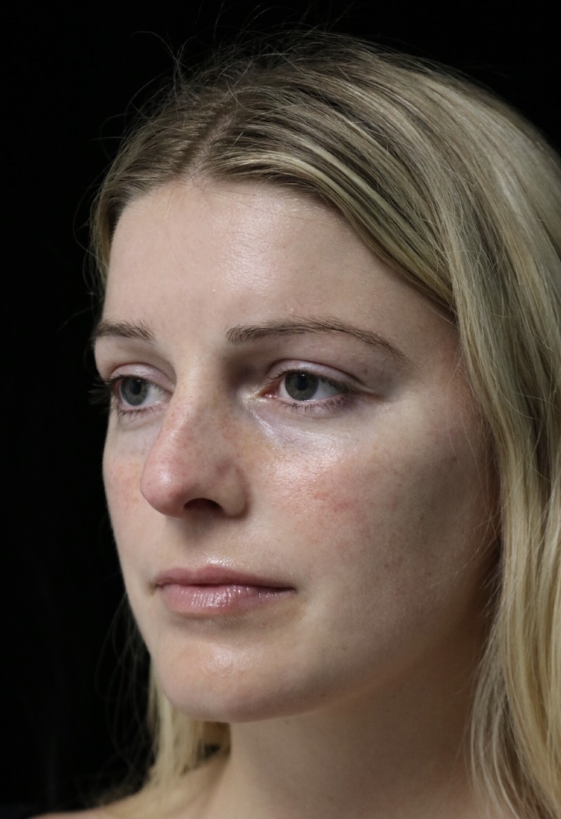 Beverly Hills Rhinoplasty Before & After Gallery - Patient 137538 - Image 7 Dr. Deepak Raj Dugar