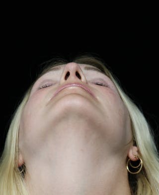 Beverly Hills Rhinoplasty Before & After Gallery - Patient 137538 - Image 10 Dr. Deepak Raj Dugar