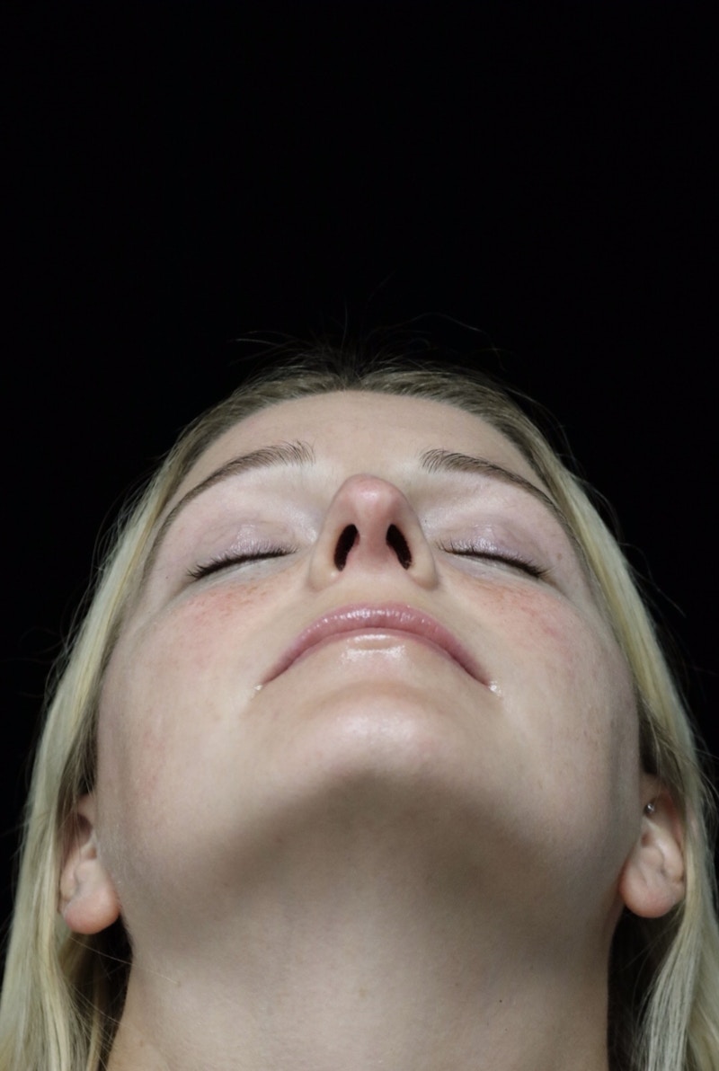 Beverly Hills Rhinoplasty Before & After Gallery - Patient 137538 - Image 9 Dr. Deepak Raj Dugar