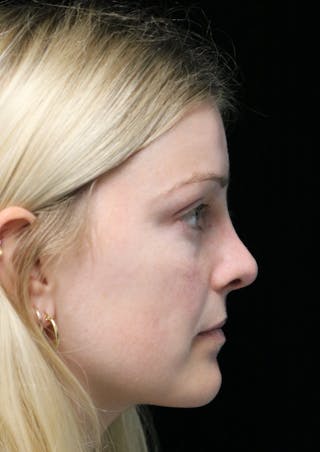 Beverly Hills Rhinoplasty Before & After Gallery - Patient 137538 - Image 2 Dr. Deepak Raj Dugar