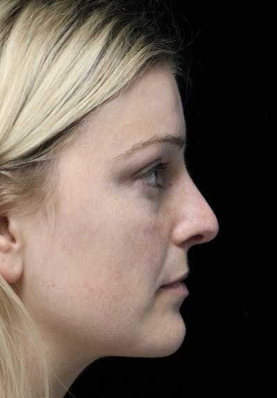 Beverly Hills Rhinoplasty Before & After Gallery - Patient 137538 - Image 1 Dr. Deepak Raj Dugar