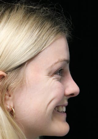 Beverly Hills Rhinoplasty Before & After Gallery - Patient 137538 - Image 12 Dr. Deepak Raj Dugar