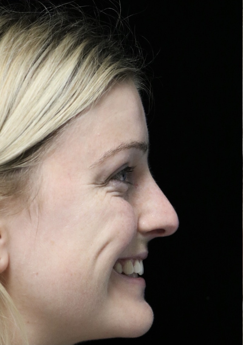 Beverly Hills Rhinoplasty Before & After Gallery - Patient 137538 - Image 11 Dr. Deepak Raj Dugar