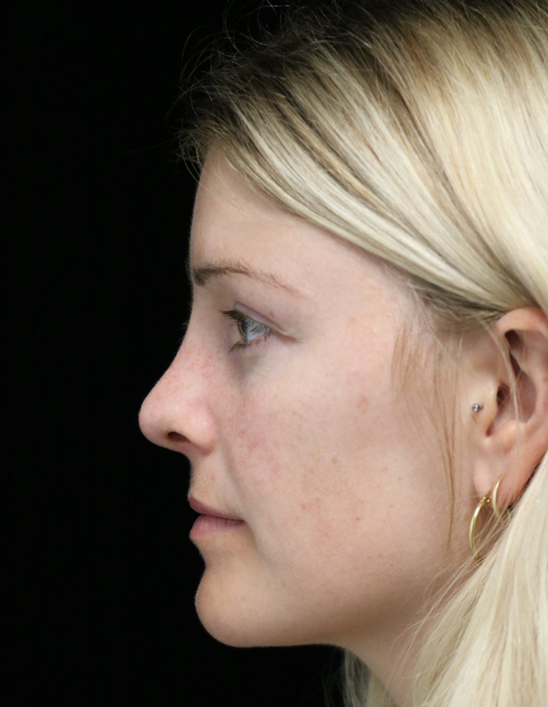 Beverly Hills Rhinoplasty Before & After Gallery - Patient 137538 - Image 14 Dr. Deepak Raj Dugar