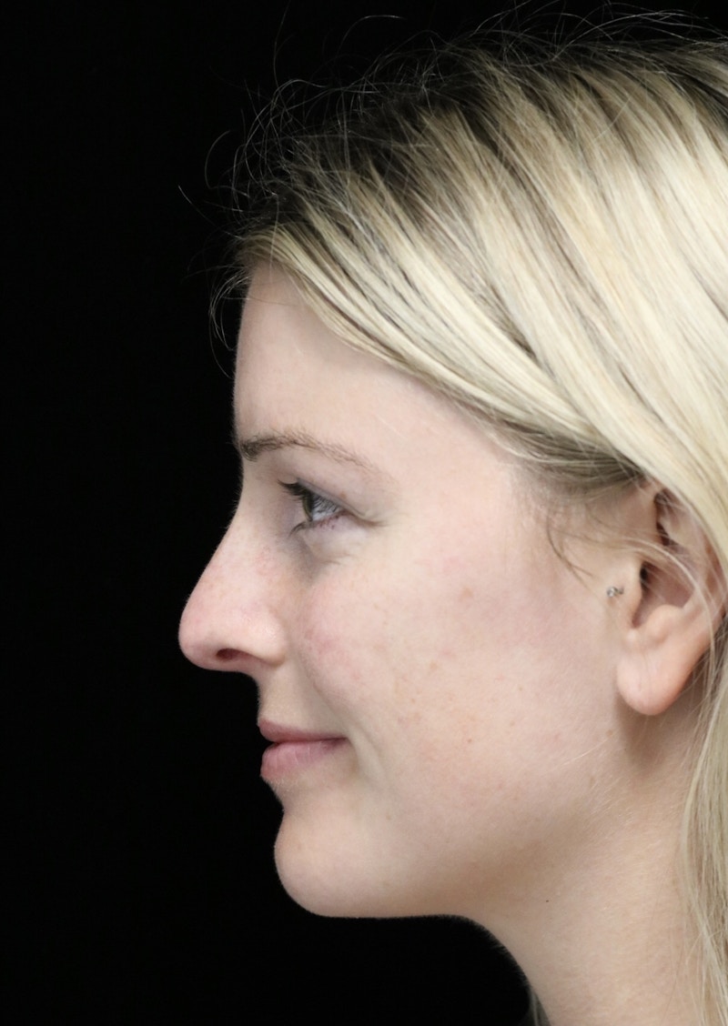 Beverly Hills Rhinoplasty Before & After Gallery - Patient 137538 - Image 13 Dr. Deepak Raj Dugar