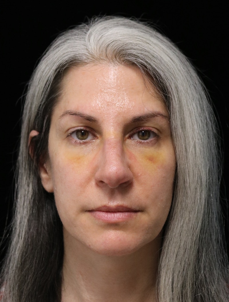 Beverly Hills Rhinoplasty Before & After Gallery - Patient 139901 - Image 4 Dr. Deepak Raj Dugar