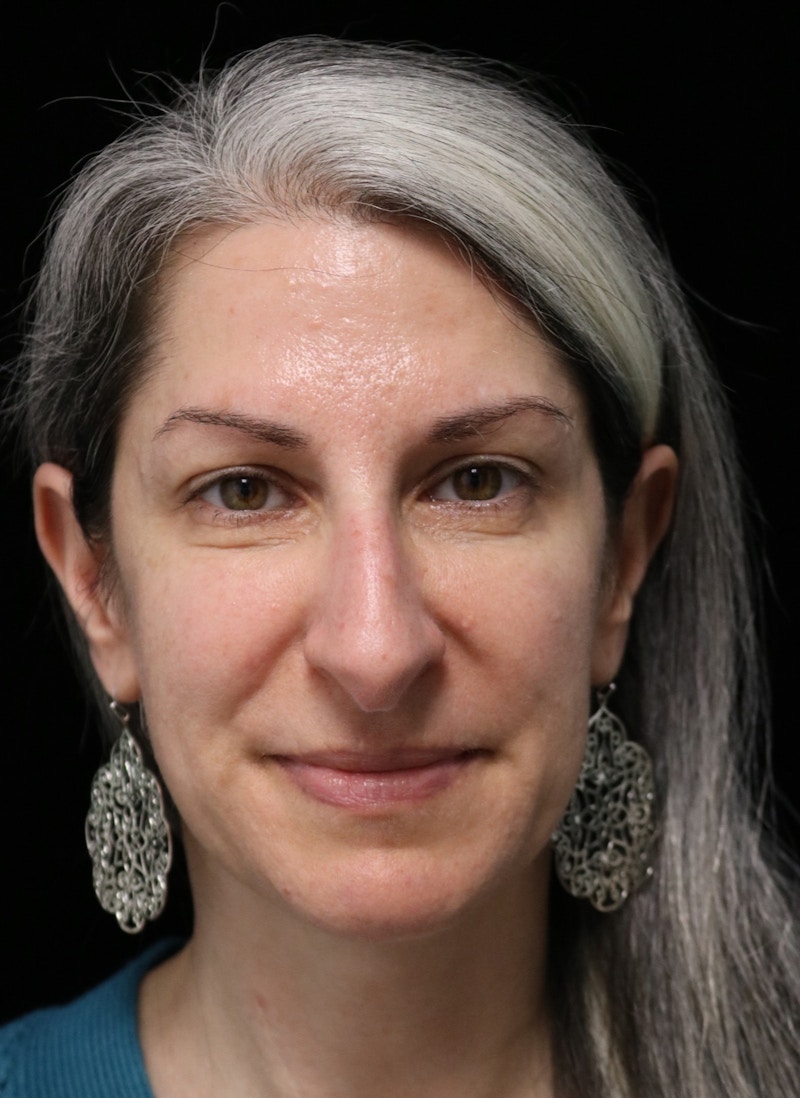 Beverly Hills Rhinoplasty Before & After Gallery - Patient 139901 - Image 3 Dr. Deepak Raj Dugar