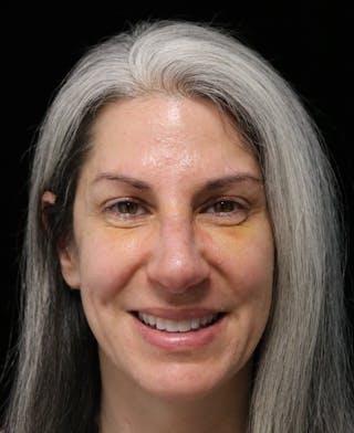 Beverly Hills Rhinoplasty Before & After Gallery - Patient 139901 - Image 6 Dr. Deepak Raj Dugar