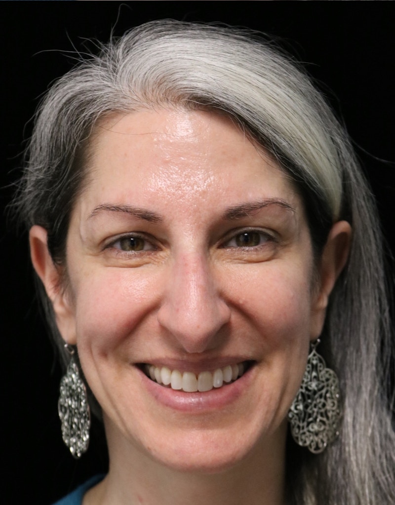 Beverly Hills Rhinoplasty Before & After Gallery - Patient 139901 - Image 5 Dr. Deepak Raj Dugar