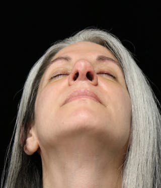 Beverly Hills Rhinoplasty Before & After Gallery - Patient 139901 - Image 8 Dr. Deepak Raj Dugar