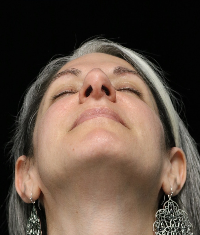 Beverly Hills Rhinoplasty Before & After Gallery - Patient 139901 - Image 7 Dr. Deepak Raj Dugar