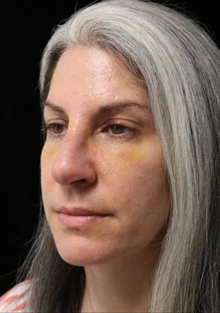 Beverly Hills Rhinoplasty Before & After Gallery - Patient 139901 - Image 10 Dr. Deepak Raj Dugar