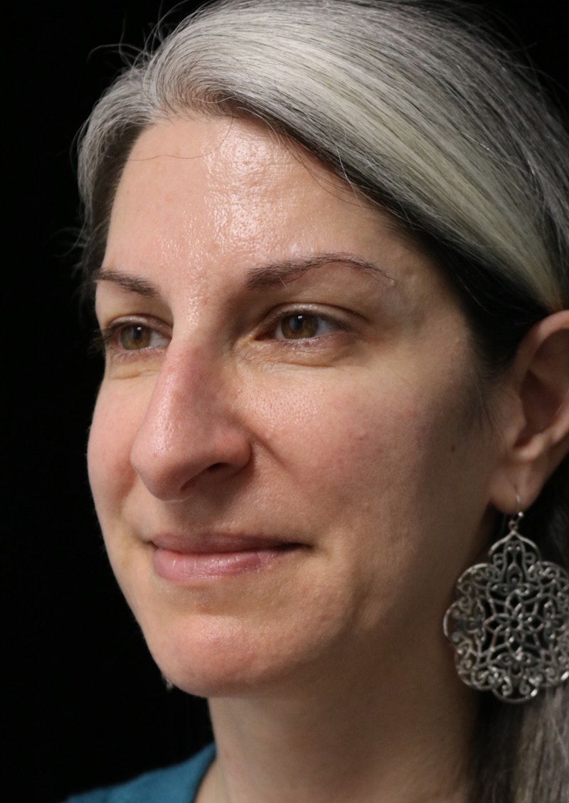 Beverly Hills Rhinoplasty Before & After Gallery - Patient 139901 - Image 9 Dr. Deepak Raj Dugar