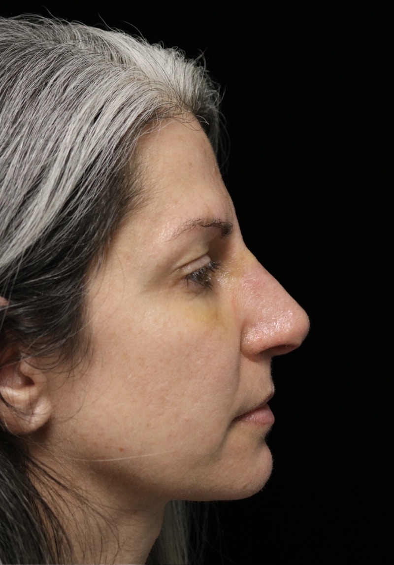 Beverly Hills Rhinoplasty Before & After Gallery - Patient 139901 - Image 2 Dr. Deepak Raj Dugar