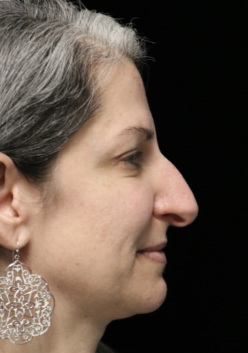 Beverly Hills Rhinoplasty Before & After Gallery - Patient 139901 - Image 1 Dr. Deepak Raj Dugar