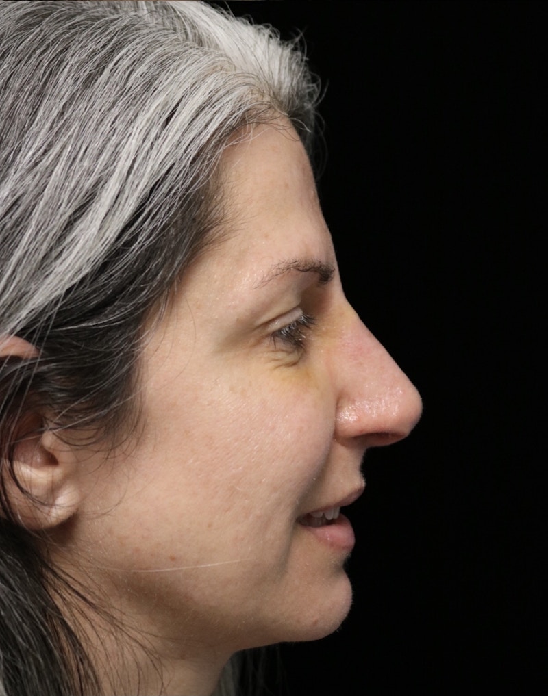 Beverly Hills Rhinoplasty Before & After Gallery - Patient 139901 - Image 12 Dr. Deepak Raj Dugar
