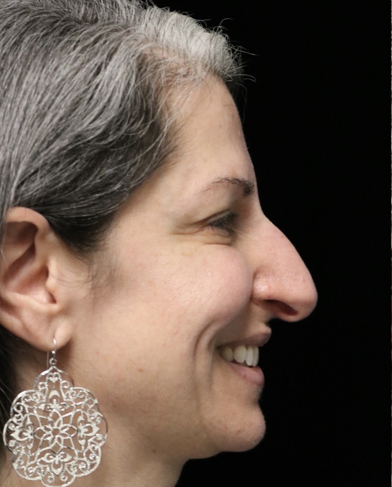 Beverly Hills Rhinoplasty Before & After Gallery - Patient 139901 - Image 11 Dr. Deepak Raj Dugar