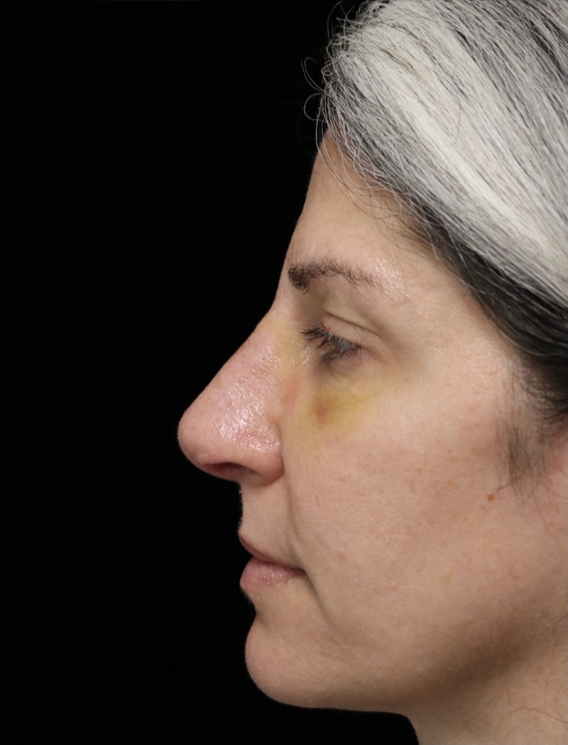 Beverly Hills Rhinoplasty Before & After Gallery - Patient 139901 - Image 14 Dr. Deepak Raj Dugar