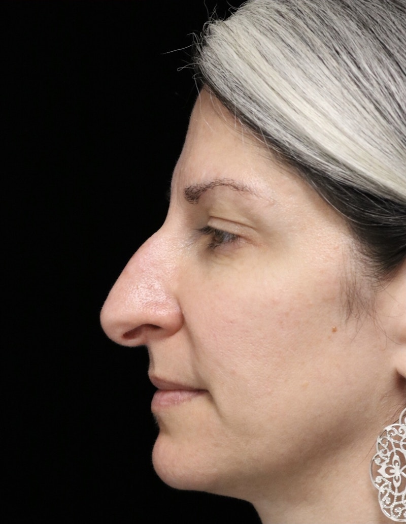 Beverly Hills Rhinoplasty Before & After Gallery - Patient 139901 - Image 13 Dr. Deepak Raj Dugar