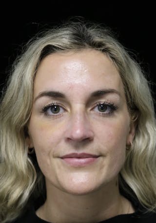 Beverly Hills Rhinoplasty Before & After Gallery - Patient 365466 - Image 4 Dr. Deepak Raj Dugar