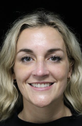 Beverly Hills Rhinoplasty Before & After Gallery - Patient 365466 - Image 6 Dr. Deepak Raj Dugar