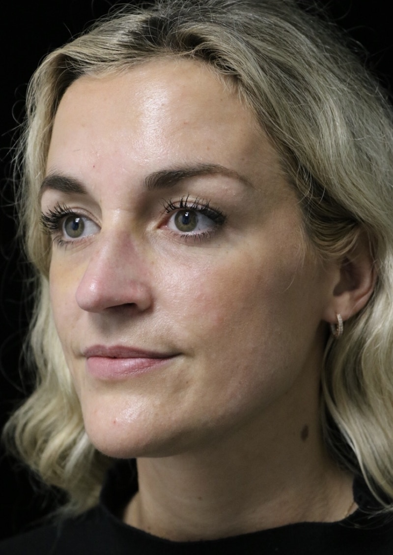 Beverly Hills Rhinoplasty Before & After Gallery - Patient 365466 - Image 8 Dr. Deepak Raj Dugar