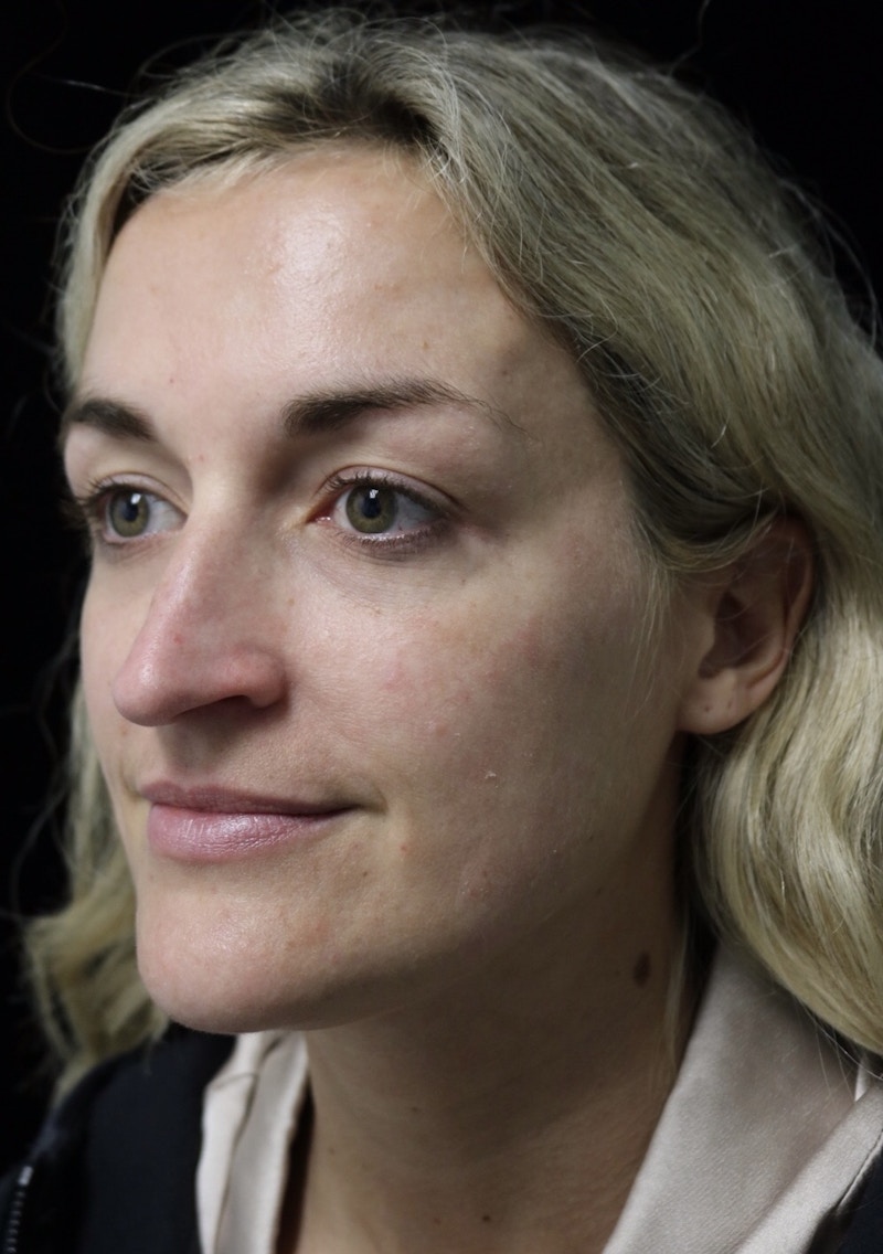 Beverly Hills Rhinoplasty Before & After Gallery - Patient 365466 - Image 7 Dr. Deepak Raj Dugar