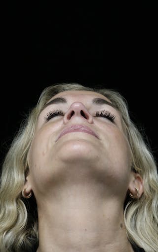 Beverly Hills Rhinoplasty Before & After Gallery - Patient 365466 - Image 10 Dr. Deepak Raj Dugar