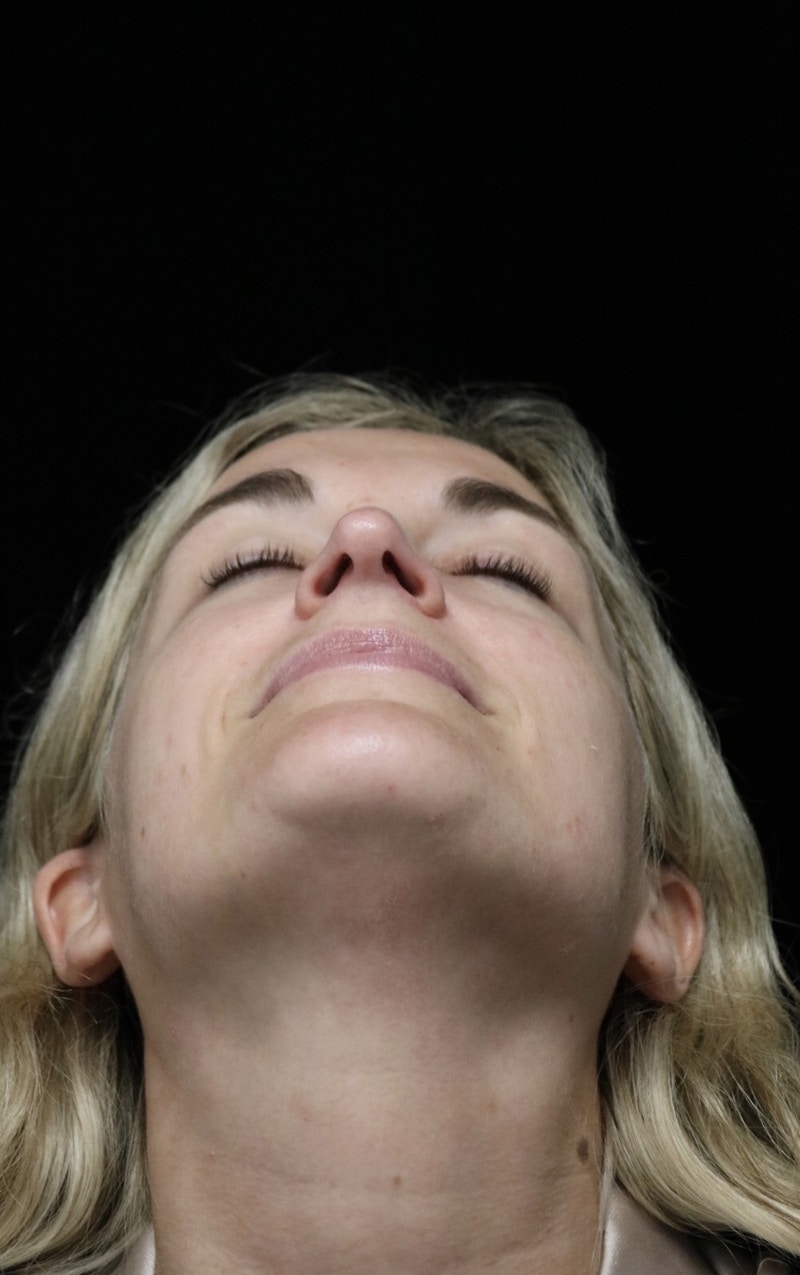 Beverly Hills Rhinoplasty Before & After Gallery - Patient 365466 - Image 9 Dr. Deepak Raj Dugar