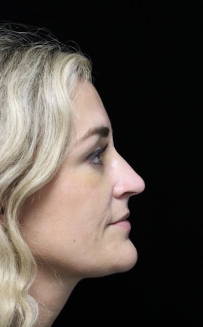 Beverly Hills Rhinoplasty Before & After Gallery - Patient 365466 - Image 2 Dr. Deepak Raj Dugar