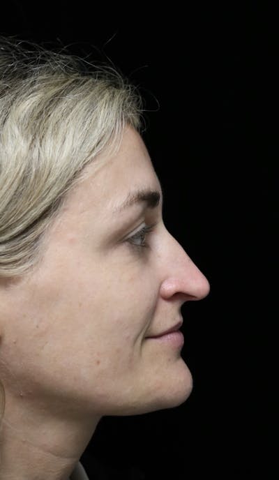 Beverly Hills Rhinoplasty Before & After Gallery - Patient 365466 - Image 1 Dr. Deepak Raj Dugar