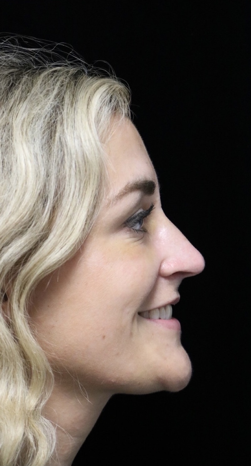 Beverly Hills Rhinoplasty Before & After Gallery - Patient 365466 - Image 12 Dr. Deepak Raj Dugar