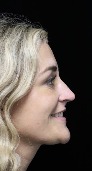 Beverly Hills Rhinoplasty Before & After Gallery - Patient 365466 - Image 12 Dr. Deepak Raj Dugar