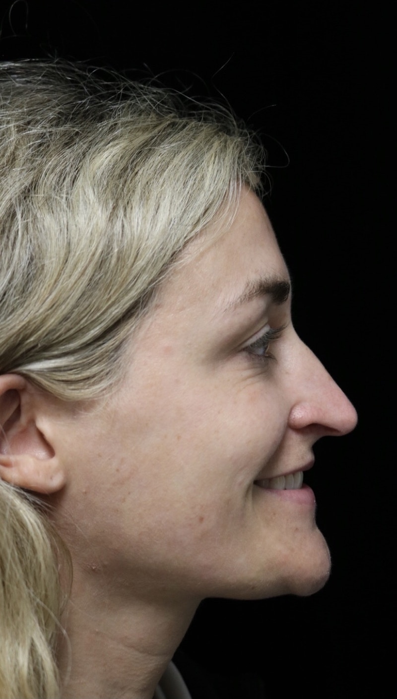 Beverly Hills Rhinoplasty Before & After Gallery - Patient 365466 - Image 11 Dr. Deepak Raj Dugar