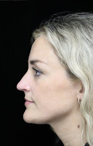 Beverly Hills Rhinoplasty Before & After Gallery - Patient 365466 - Image 14 Dr. Deepak Raj Dugar