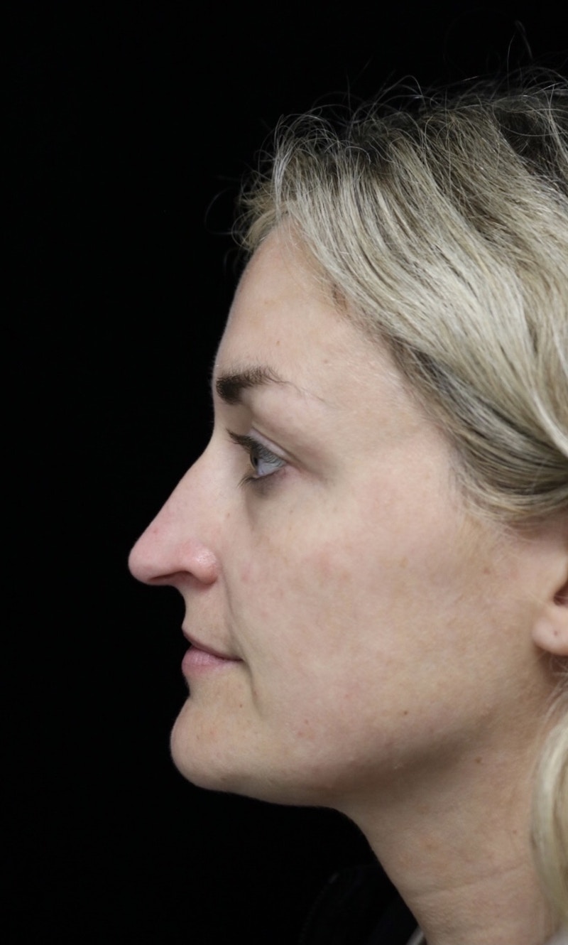 Beverly Hills Rhinoplasty Before & After Gallery - Patient 365466 - Image 13 Dr. Deepak Raj Dugar