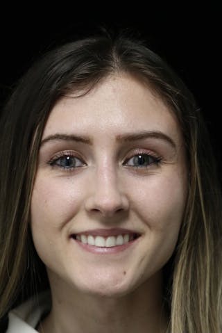 Beverly Hills Rhinoplasty Before & After Gallery - Patient 356296 - Image 4 Dr. Deepak Raj Dugar