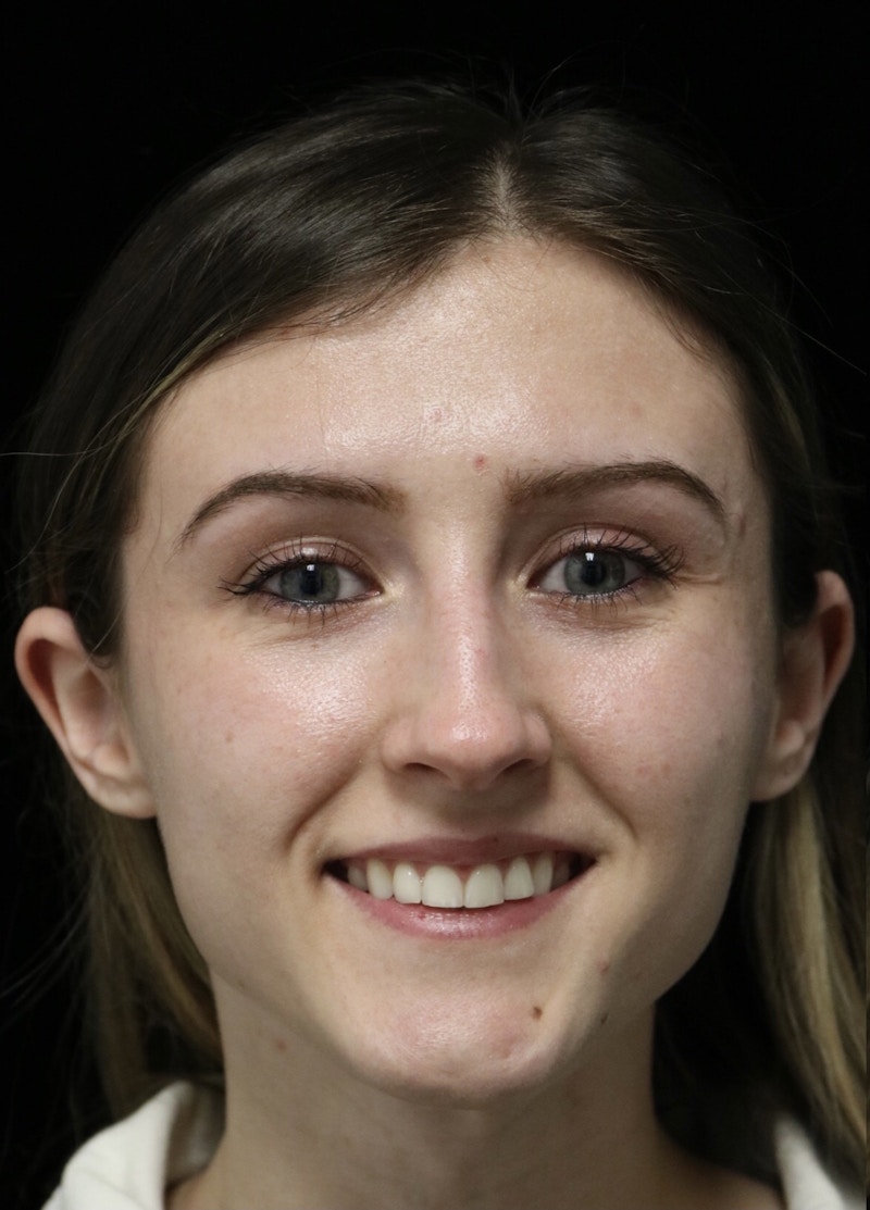 Beverly Hills Rhinoplasty Before & After Gallery - Patient 356296 - Image 3 Dr. Deepak Raj Dugar