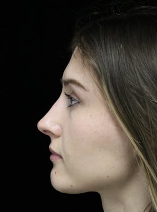 Beverly Hills Rhinoplasty Before & After Gallery - Patient 356296 - Image 6 Dr. Deepak Raj Dugar