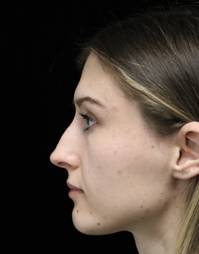 Beverly Hills Rhinoplasty Before & After Gallery - Patient 356296 - Image 5 Dr. Deepak Raj Dugar