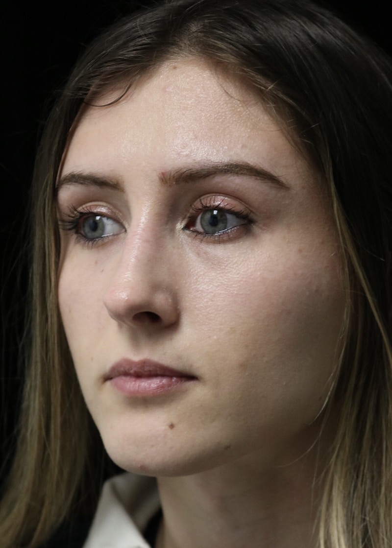 Beverly Hills Rhinoplasty Before & After Gallery - Patient 356296 - Image 8 Dr. Deepak Raj Dugar