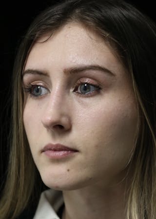 Beverly Hills Rhinoplasty Before & After Gallery - Patient 356296 - Image 8 Dr. Deepak Raj Dugar