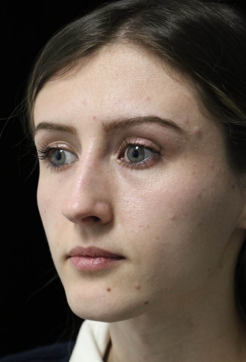 Beverly Hills Rhinoplasty Before & After Gallery - Patient 356296 - Image 7 Dr. Deepak Raj Dugar