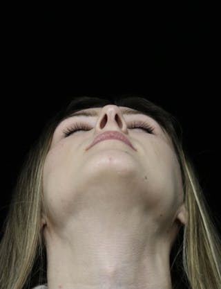 Beverly Hills Rhinoplasty Before & After Gallery - Patient 356296 - Image 10 Dr. Deepak Raj Dugar