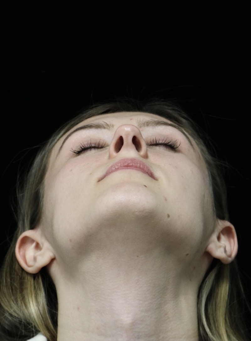 Beverly Hills Rhinoplasty Before & After Gallery - Patient 356296 - Image 9 Dr. Deepak Raj Dugar